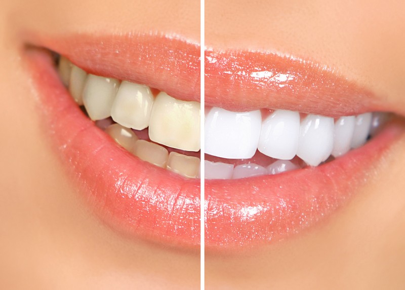 Teeth Whitening Winnemucca, NV 